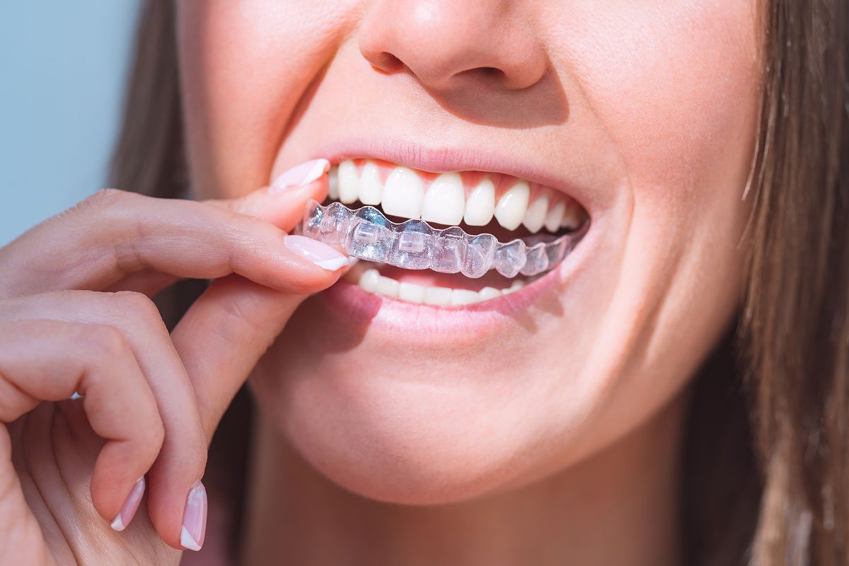 Invisalign offered at Hopewell Family Dentistry