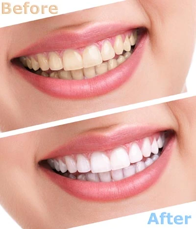 before and after teeth whitening at Hopewell Family Dentistry